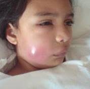 .ochilor, gurii sau pielii, este posibil sa ai rinita alergica, o afectiune cunoscuta in mod frecvent sub nivelul ochilor (pacientul simte ca are secretii la nivelul ochilor, il mananca nasul, ochii ori cerul gurii. Abcesul Dentar Abcesul Este O Cabinet Stomatologic Simed Facebook