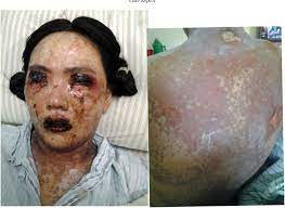 Steven johnson syndrome and motrin. A Case Of Stevens Johnson Syndrome With Gross Hematuria Semantic Scholar