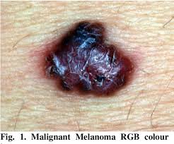 Melanoma can be anywhere on your body. Pdf Automated Malignant Melanoma Detection Using Matlab Semantic Scholar