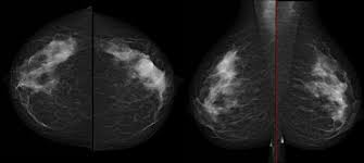 Breast screening aims to find breast cancers early. Deep Learning In Breast Cancer Detection
