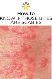 How To Know If That Rash Is Scabies Everyday Health Home Remedies For Scabies Scabies Scabies Rash