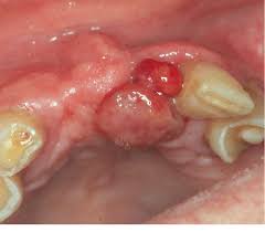 Image result for granuloma gum disease