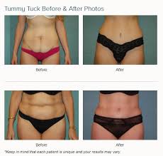 While abdominoplasty procedures are not covered by ohip, a panniculectomy may be covered, depending on the situation. Abdominoplasty Las Vegas Dr Arthur Cambeiro