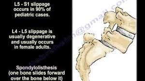 The thoracic vertebrae are bones located between the cervical and lumbar vertebrae. Spondylolysis Spondylolisthesis Spondylitis Spondylosis Everythingyou Need To Know Dr Nabil Ebraheim Youtube