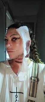 Face-lift & Neck-lift Support Group