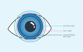 Image result for Lens