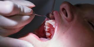 Entzundung Des Kiefers