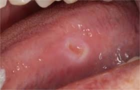 Image result for mouth ulcer on tongue)