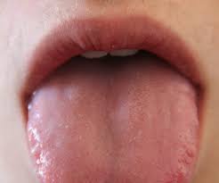 Image result for mouth ulcer on tongue)