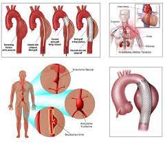 Un aneurisma aórtico es un bulto en una sección de la aorta, la arteria principal del cuerpo. Aneurismas Aorta Toracica Aneurismas Com Mx