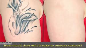 The picosure laser that we use at zapp laser studio is the fastest, safest and most effective laser in the world for tattoo removal. How Much Time Will It Take To Remove Tattoos Avana Laser Clinic Auckland