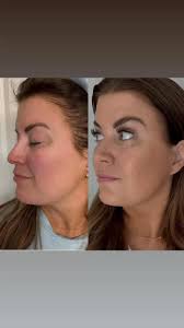 This is what it looks like when you increase your collagen by 1223% , I own  a salon. I’ve tried it all. I’m telling you nothing compares. Needles don’t  do this alone!, Here’s my tip:, 1.Get the ...
