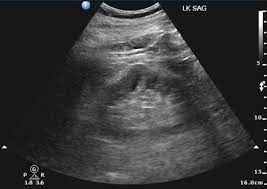 1 article features images from this case. Dromedary Hump Radiology Reference Article Radiopaedia Org