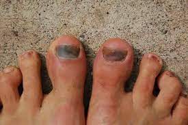 Red or black nails due to a hematoma, or blood under the nail, usually occur from trauma (like whacking yourself. Black Toenail Cancer Things You Must Know Nedufy