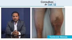 Maybe you would like to learn more about one of these? Trombosis Venosa Profunda Consultas De Salud Youtube