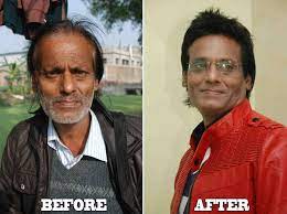 Gallery Shaan Khan Hair Transplant