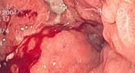 The highest incidence rates are found in eastern asia, latin america and eastern europe. Stomach Cancer Causes Symptoms And Treatment