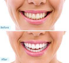 Maybe you would like to learn more about one of these? Zoom Teeth Whitening Treatment Lane Associates Family Dentistry