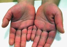 The redness of palmar erythema is due to increased dilatation of surface capillaries in the hand. File Palmar Erythema 1 Jpg Wikidoc