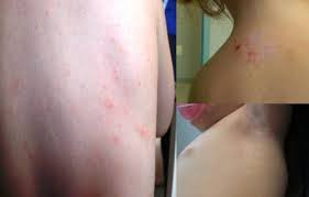 Image result for mite bites on humans
