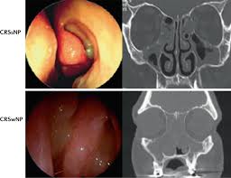Image result for Rhinosinusitis
