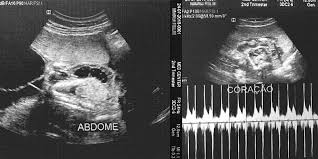 787 likes · 8 talking about this. Um Aborto A Cada Quatro Gravidas A Cidade Em Que O Glifosato Geral