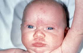 Birthmarks: Signs and symptoms