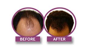 Get Hair Transplant In Navi Mumbai Kharghar Just 39999 Rs Hair Transplant Cost Hair Transplant Hair Transplant Procedure