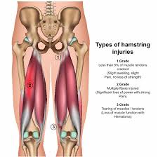 The hamstring muscles are very susceptible to tears, strains and other common sporting injuries. How To Predict A Hamstring Injury In Afl