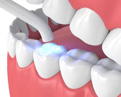 Composite Fillings