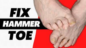 Image result for Hammer toe
