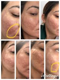 Hi Guys I did my Fibroblast