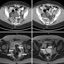 Check spelling or type a new query. Remote Recurrence Of Benign Multicystic Peritoneal Mesothelioma Journal Of Obstetrics And Gynaecology Canada