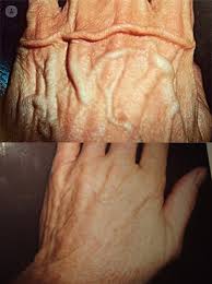 We did not find results for: Is It Possible To Remove Bulging Veins In The Hand