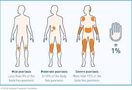 Image result for psoriasis