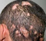 Candida fungus can also occur on the scalp, causing a type of hair loss called scarring alopecia. Fungal Infections That Cause Hair Loss Dermatophytes