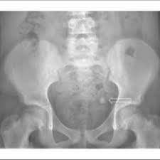 The symptoms of this infection can be quite severe. Plain Abdominal X Ray Demonstrating A Radioopaque Structure In The Left Download Scientific Diagram