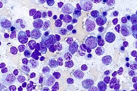 Clinical and laboratory features at diagnosis in 77 patients. Angioimmunoblastic T Cell Lymphoma 8