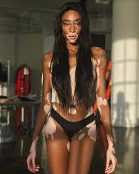 She modeled the clay into a sculpture. Model Winnie Harlow Wants Everyone To Know She Isn T Suffering From Vitiligo