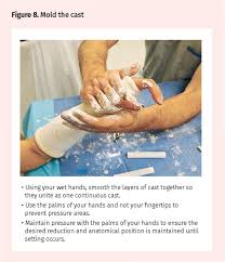 Image result for Short Arm Cast