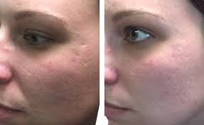 new acne scar filler makeup topical