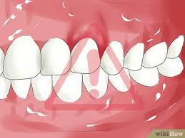 Check spelling or type a new query. How To Know If You Have An Infected Tooth 7 Steps With Pictures