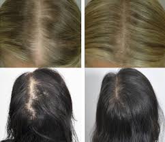 During a hair transplant procedure, a dermatologist or cosmetic surgeon removes hair from a part of the head that has hair and transplants it to a bald interventions for female pattern hair loss. Cwuzswawjqng8m