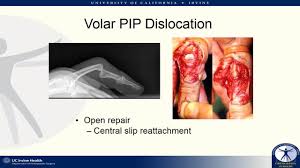 Image result for Volar PIP Dislocation