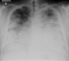 The bacterium is found naturally in fresh water. Legionnaires Disease Wikipedia