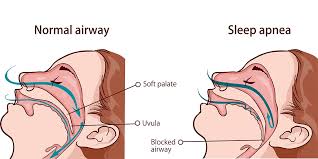 Image result for Sleep Apnea