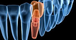 We did not find results for: Dental Implants Wisdom Teeth Dental Implants Colleyville Oral Surgeon
