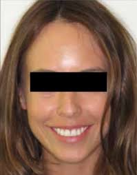 A predictable alternative to a smile in six months?