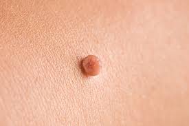 Image result for Skin Tag