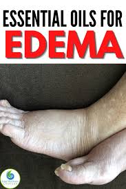 Top 5 Essential Oils For Swollen Feet And Ankles Essential Oils Essential Oil Perfumes Recipes Living Essentials Oils